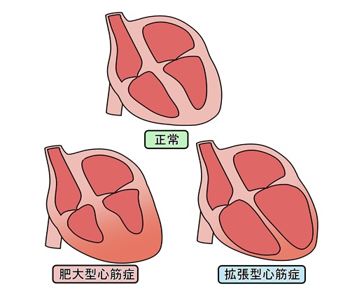 心筋症